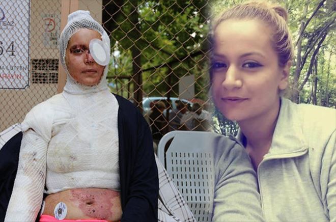 KOCASININ KEZZAPLA YAKTIĞI ZEHRA ELBER YARDIM BEKLİYOR
