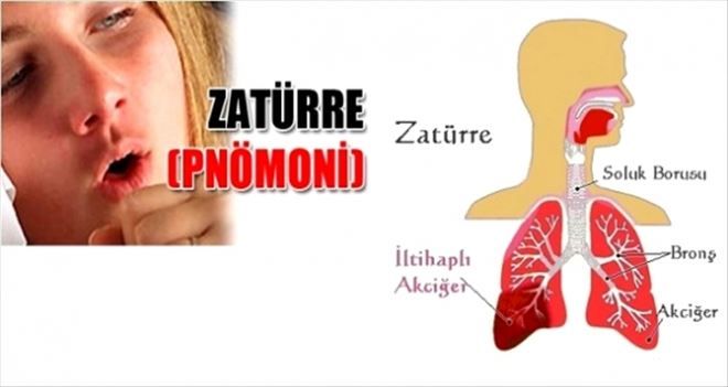 YILDA 3 BİN KİŞİ ZATÜRREDEN ÖLÜYOR